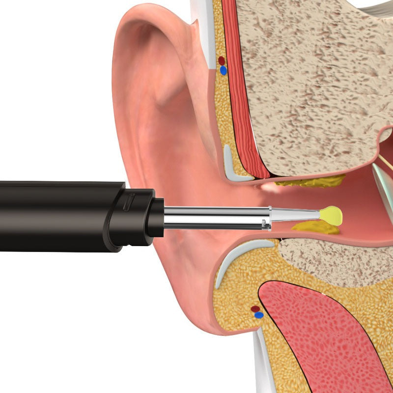 Ear Wax Removal with 10 Pcs Ear Set